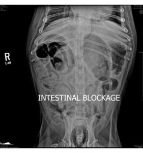 intestinal-blockage x-ray