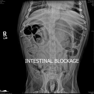 intesinal blockage x-ray